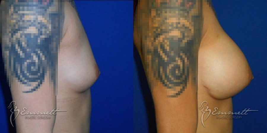 Breast Augmentation - Thumbnail 3