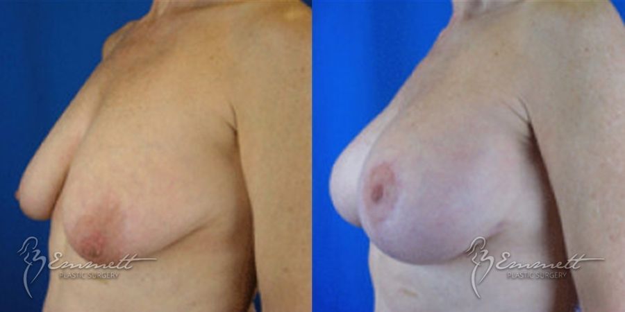 Breast Augmentation - Thumbnail 3