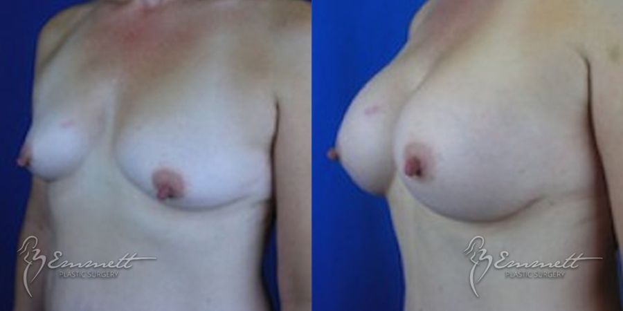 Breast Augmentation - Thumbnail 3