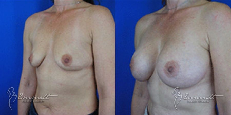 Breast Augmentation - Thumbnail 3