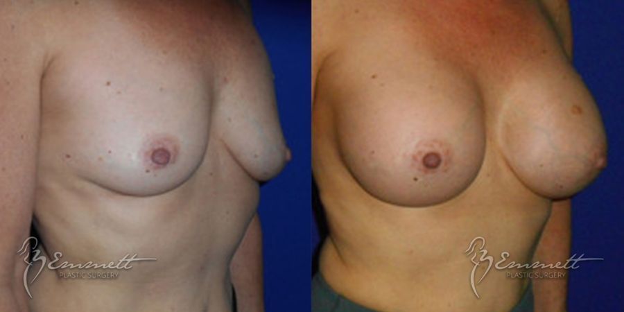 Breast Augmentation - Thumbnail 2