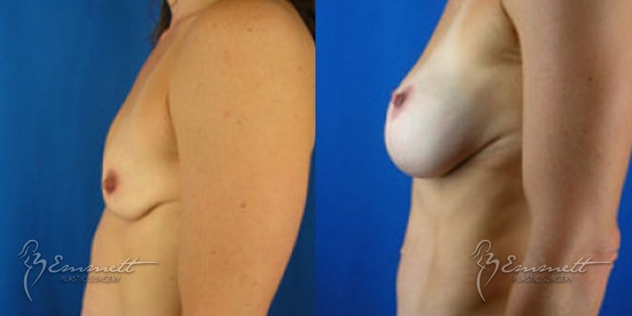 Breast Augmentation - Thumbnail 3