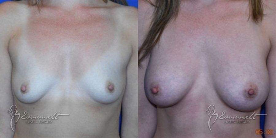 Breast Augmentation - Case 24448