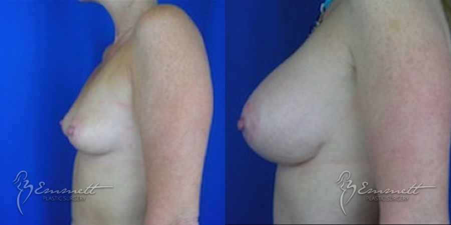 Breast Augmentation - Thumbnail 3