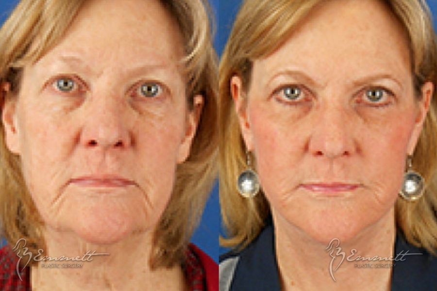 Facelift & Neck Lift - Case 24421