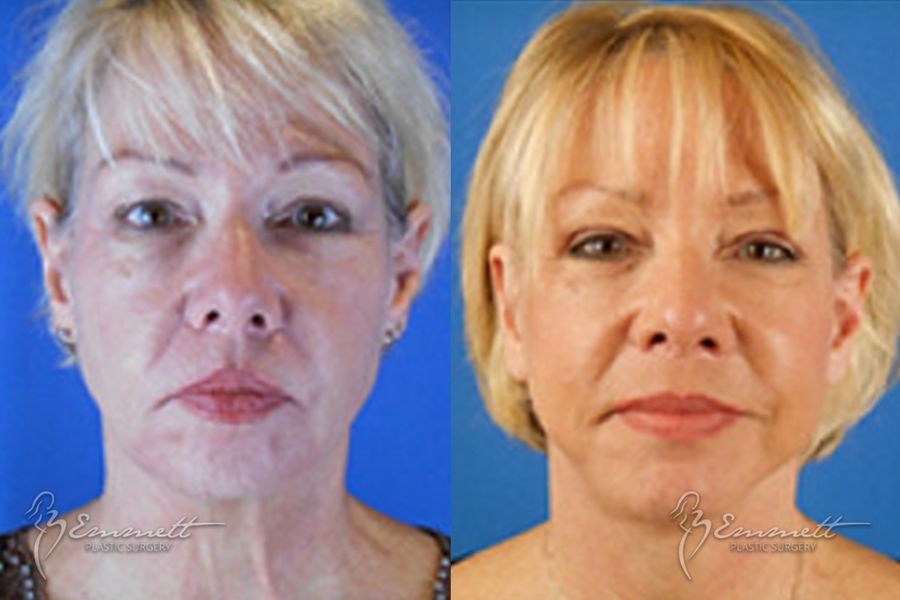 Facelift & Neck Lift - Case 24424
