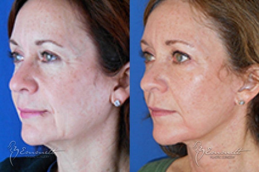 Facelift & Neck Lift - Case 24422
