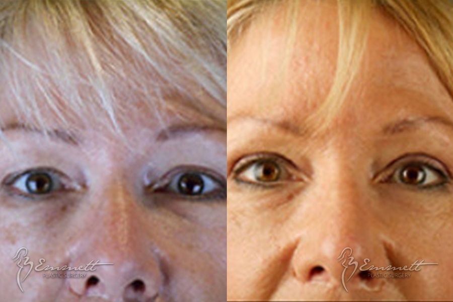 Facelift & Neck Lift - Thumbnail 5