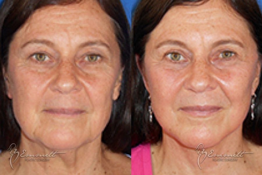 Facelift & Neck Lift - Case 24419