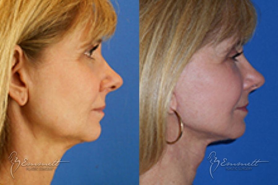 Facelift & Neck Lift - Thumbnail 3