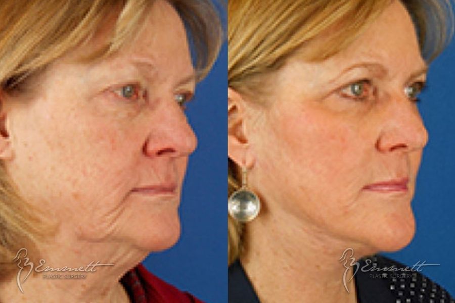 Facelift & Neck Lift - Thumbnail 2