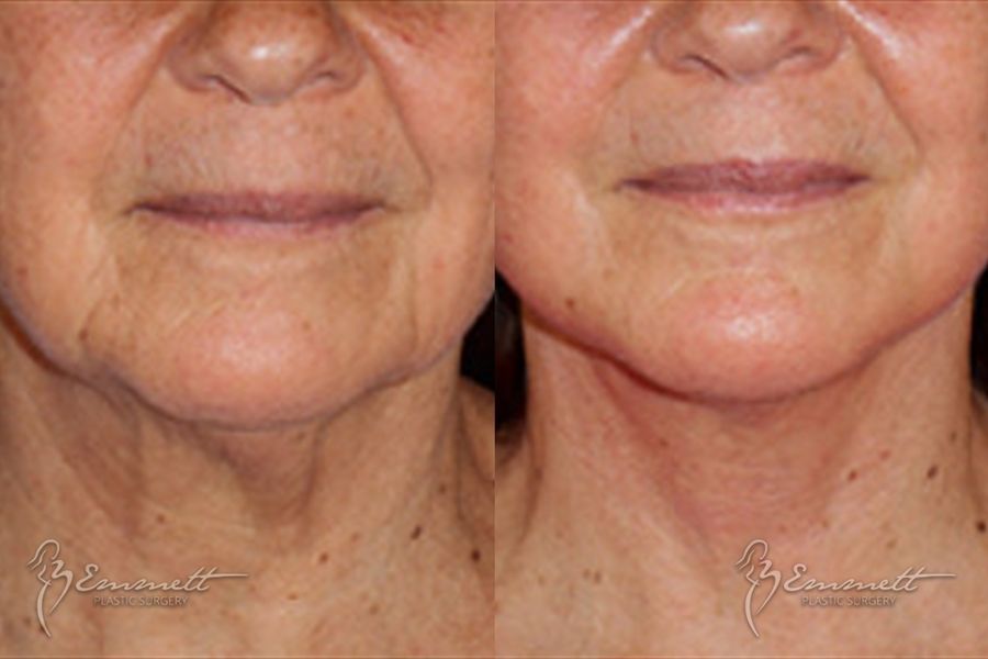 Facelift & Neck Lift - Thumbnail 4