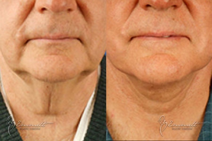 Facelift & Neck Lift - Thumbnail 4