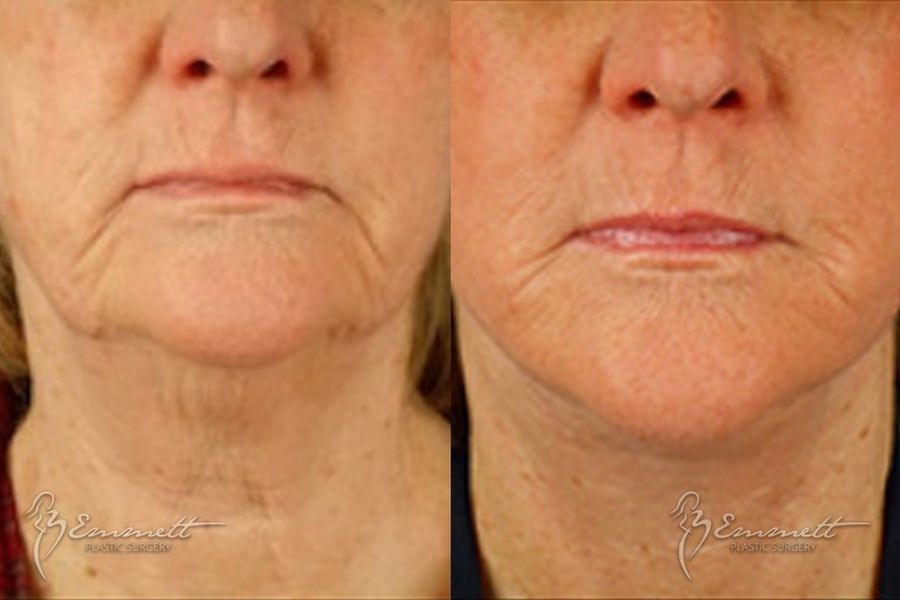 Facelift & Neck Lift - Thumbnail 4