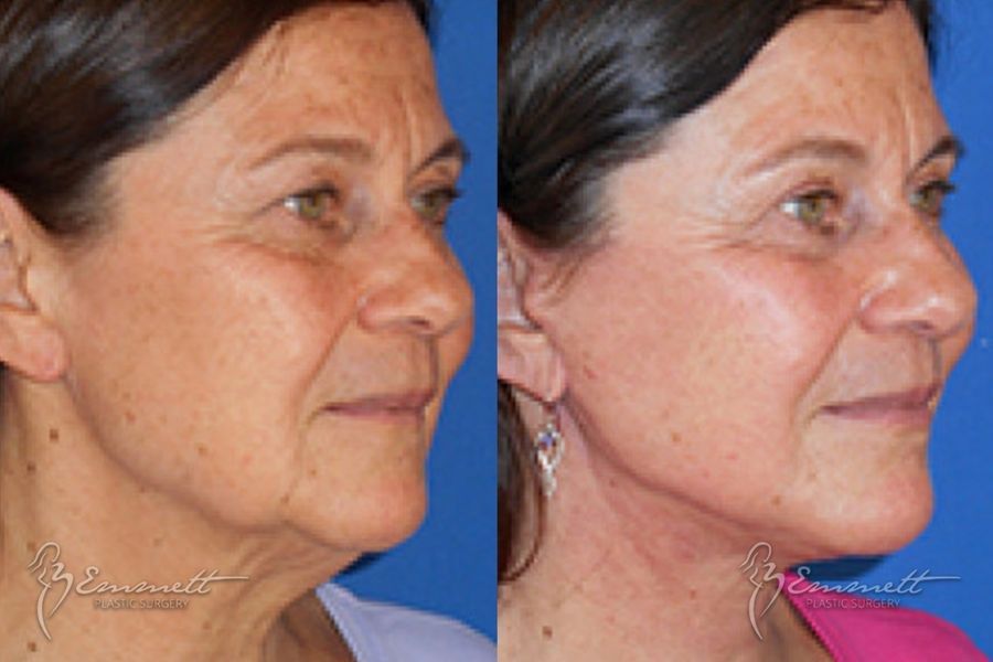 Facelift & Neck Lift - Thumbnail 2