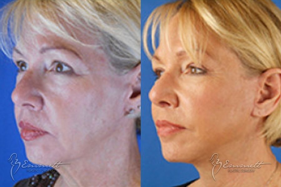 Facelift & Neck Lift - Thumbnail 2