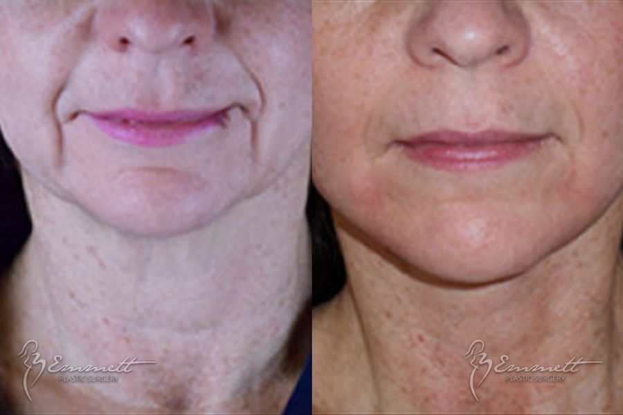 Facelift & Neck Lift - Thumbnail 4