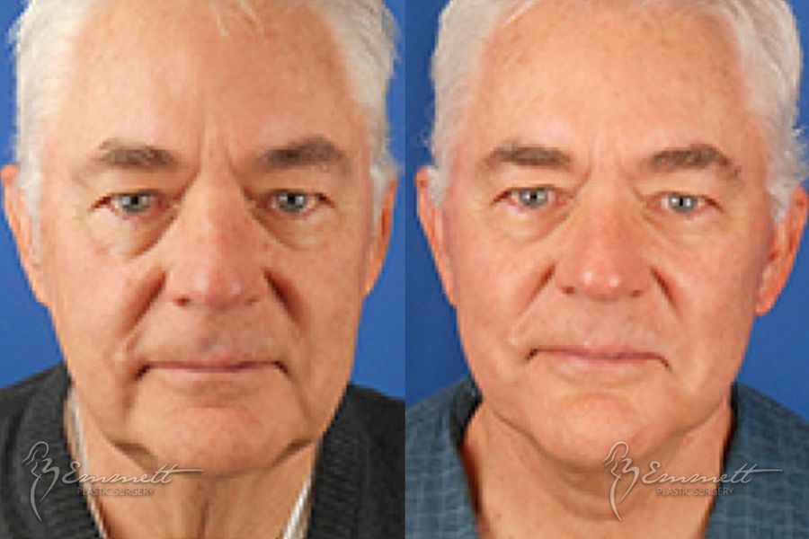 Facelift & Neck Lift - Case 24423