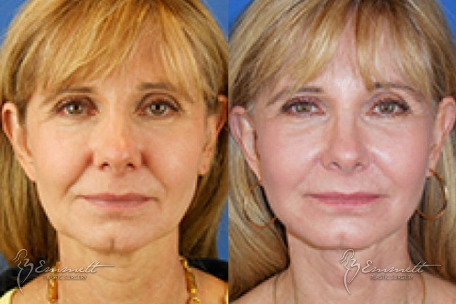 Facelift & Neck Lift - Case 24420