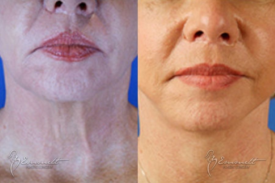 Facelift & Neck Lift - Thumbnail 4