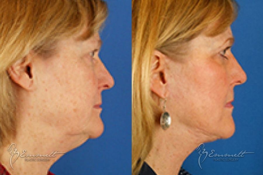 Facelift & Neck Lift - Thumbnail 3