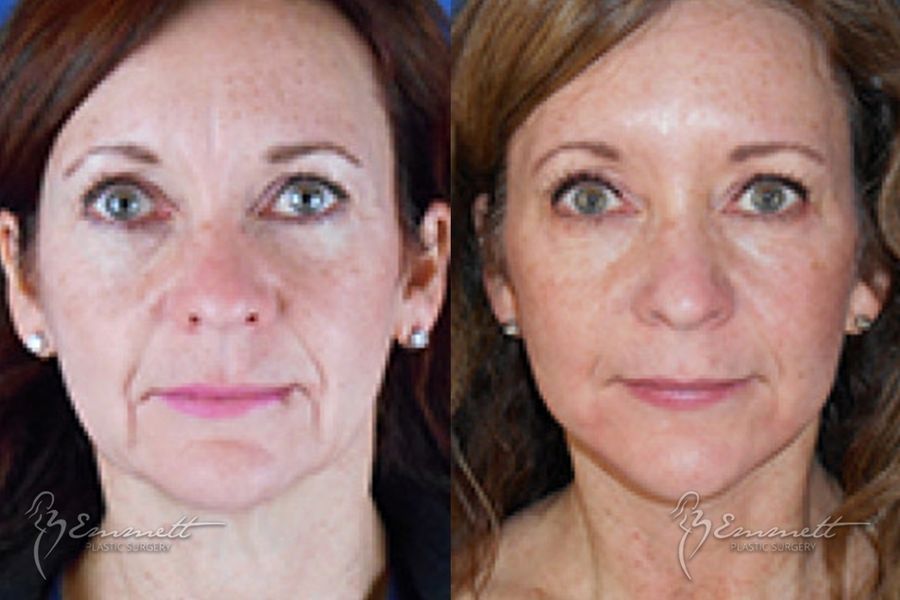 Facelift & Neck Lift - Thumbnail 2
