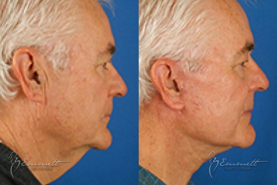 Facelift & Neck Lift - Thumbnail 3