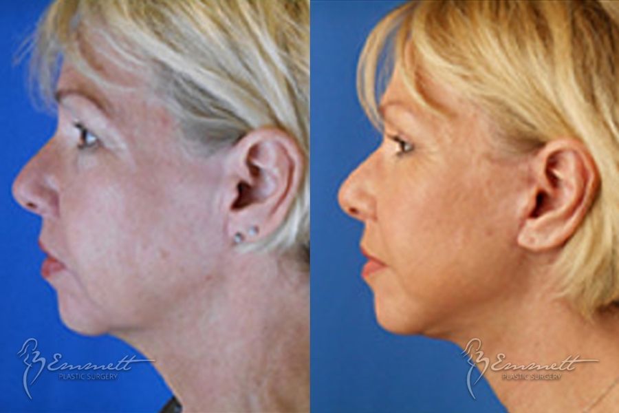 Facelift & Neck Lift - Thumbnail 3
