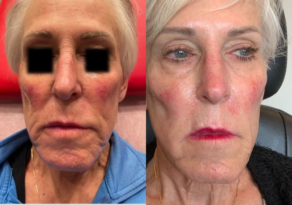Laser Skin Resurfacing - Case 24434