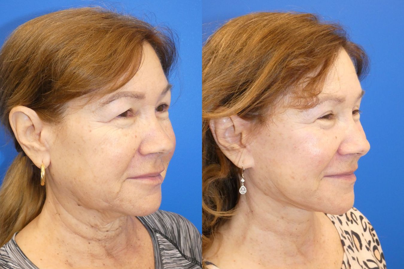 Before and after Facelift case 46281 - Angle 4