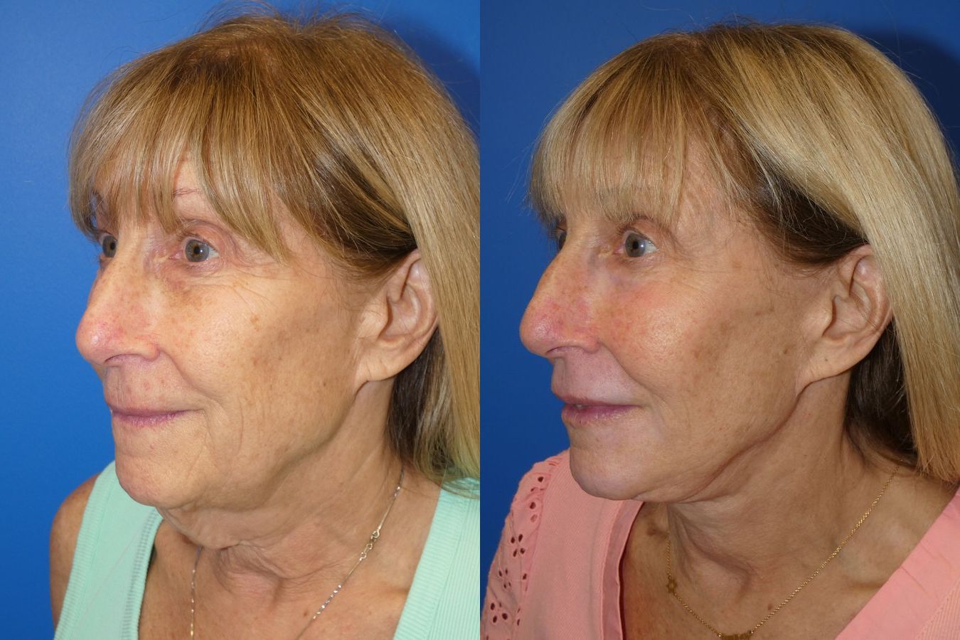 Before and after Facelift case 46278 - Angle 2