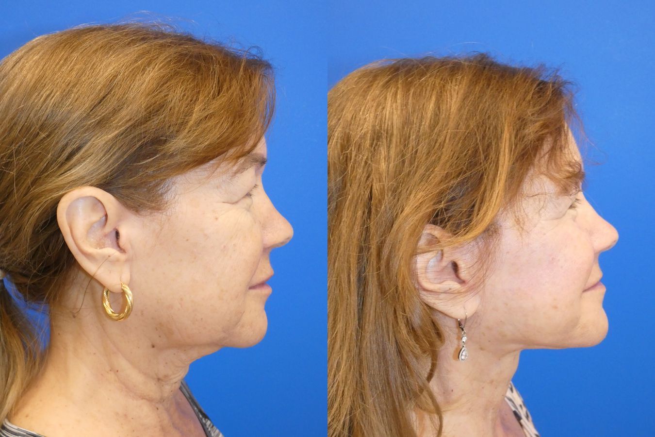 Before and after Facelift case 46281 - Angle 5