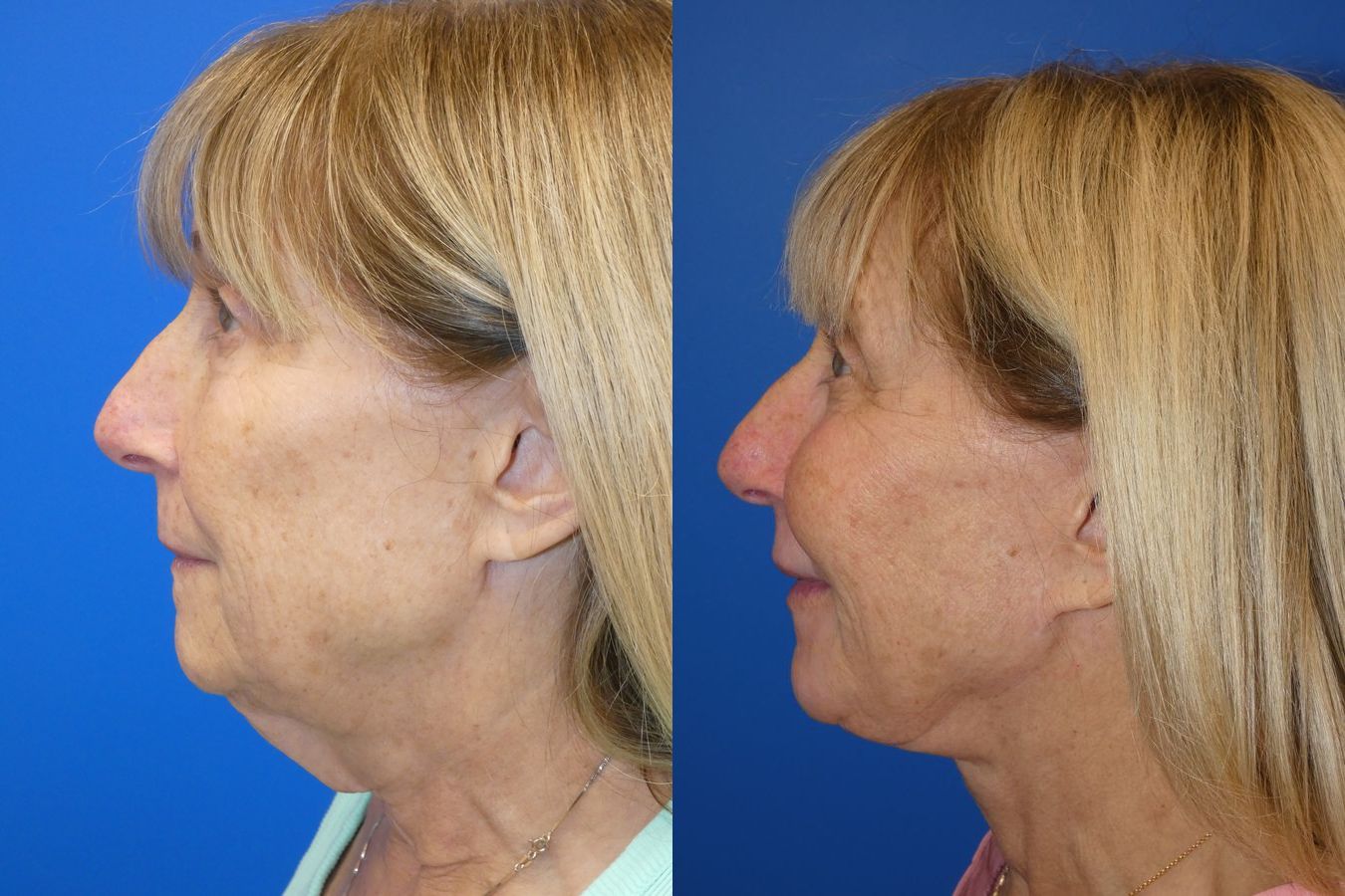 Before and after Facelift case 46278