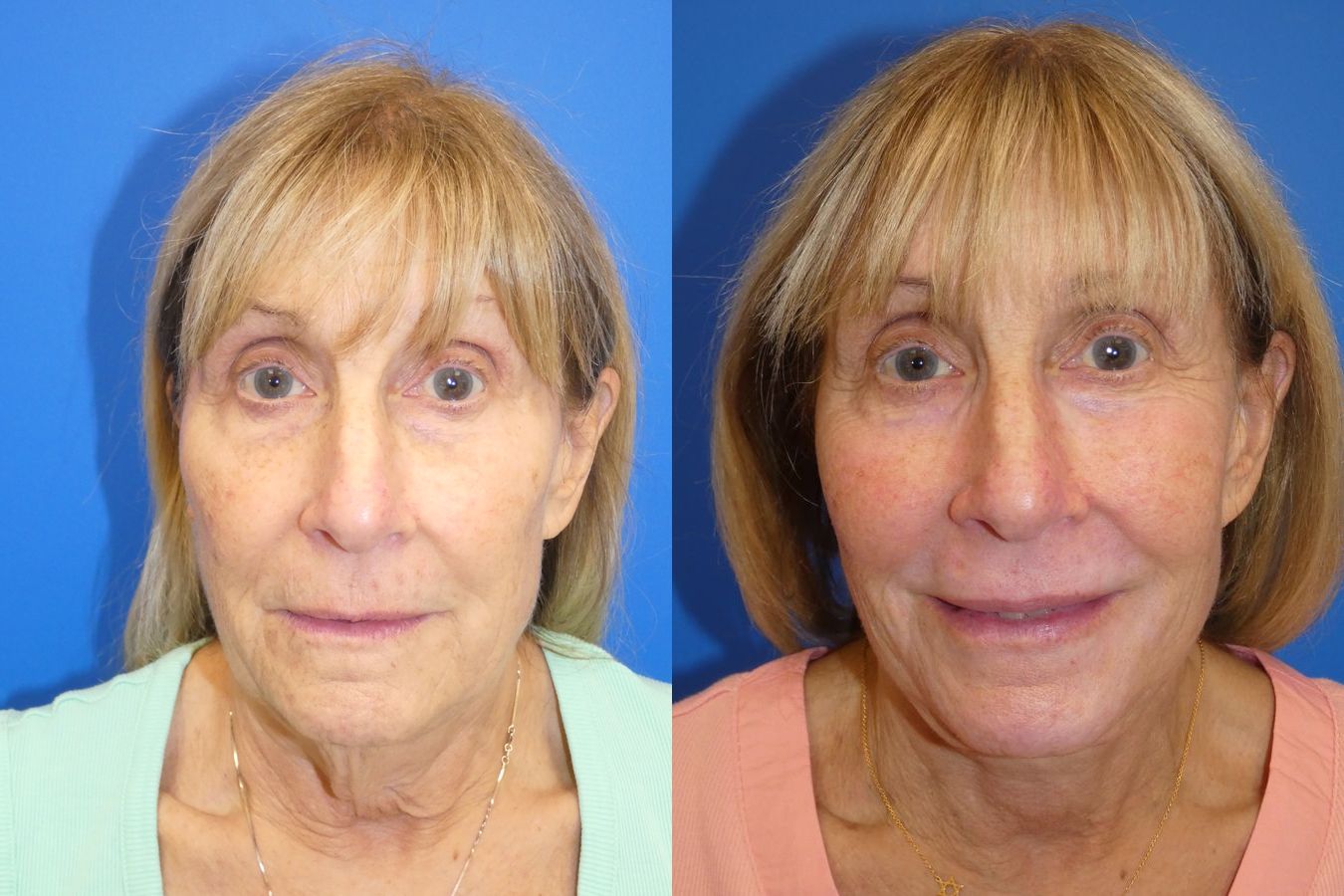 Before and after Facelift case 46278 - Angle 3