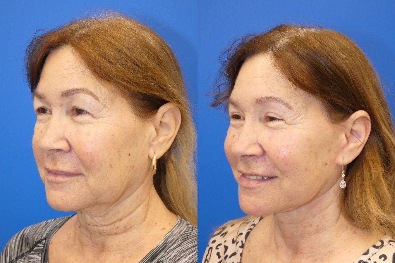 Before and after Facelift case 46281 - Angle 2