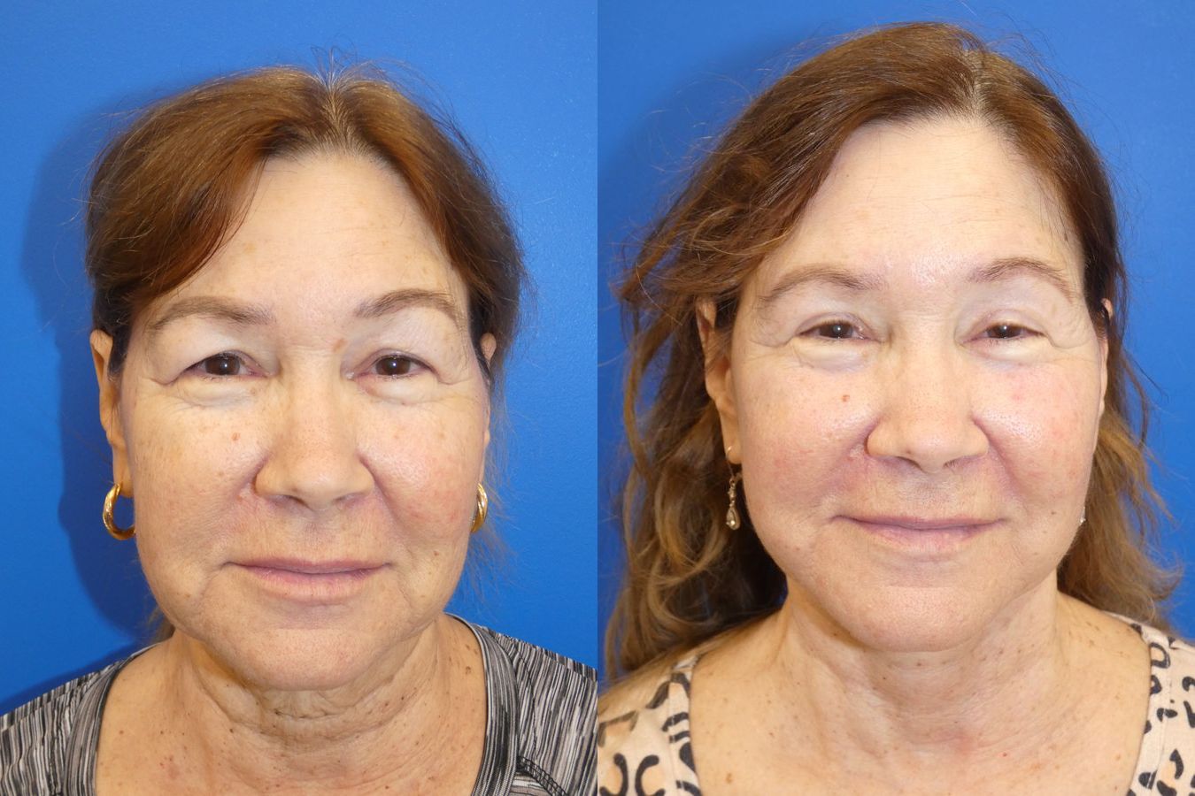 Before and after Facelift case 46281 - Angle 3
