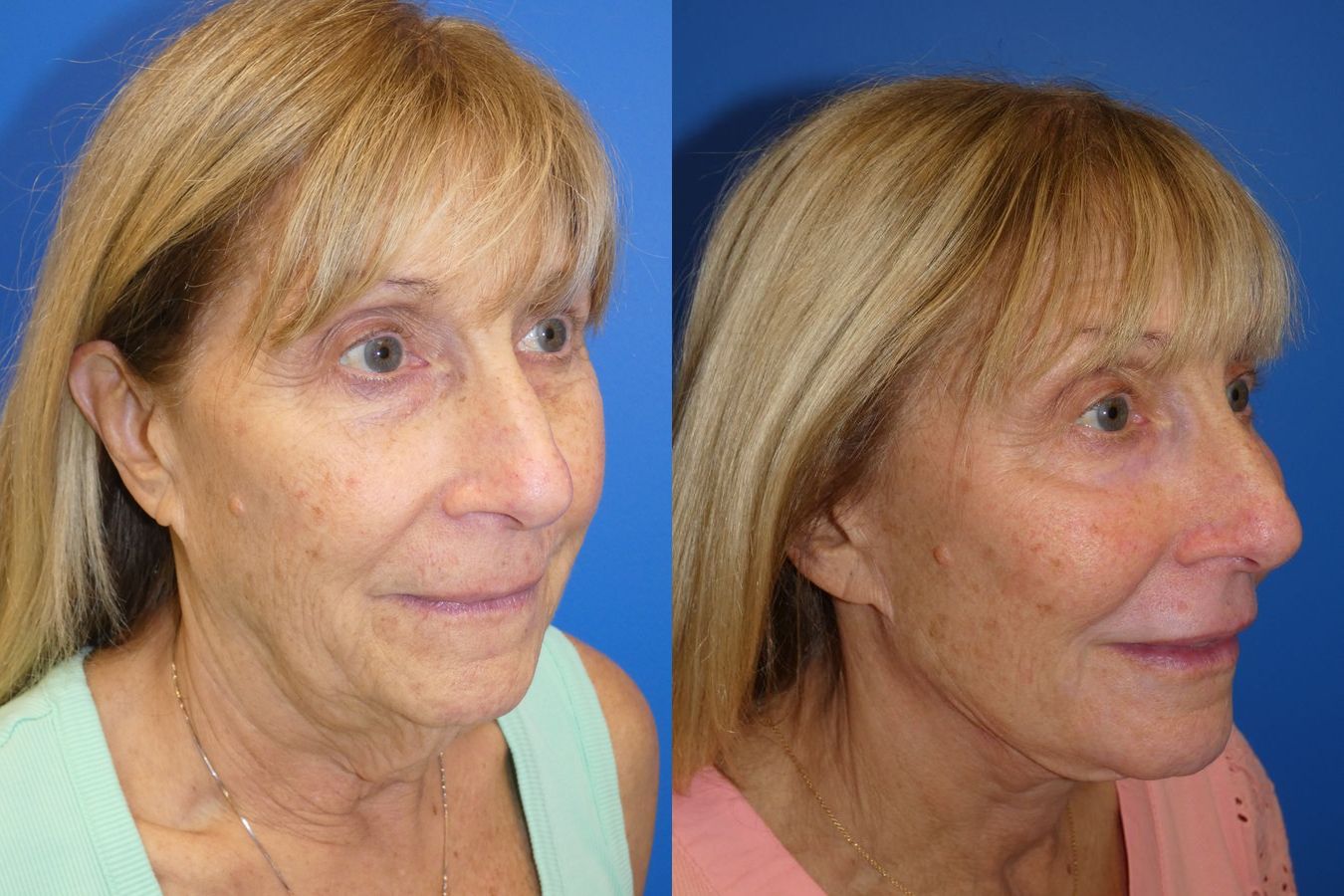 Before and after Facelift case 46278 - Angle 4