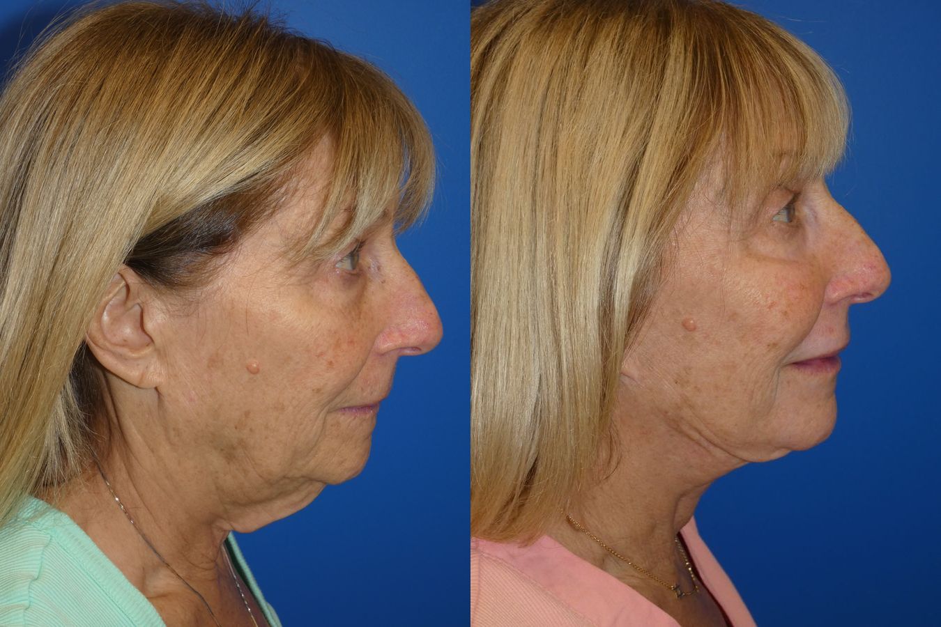 Before and after Facelift case 46278 - Angle 5