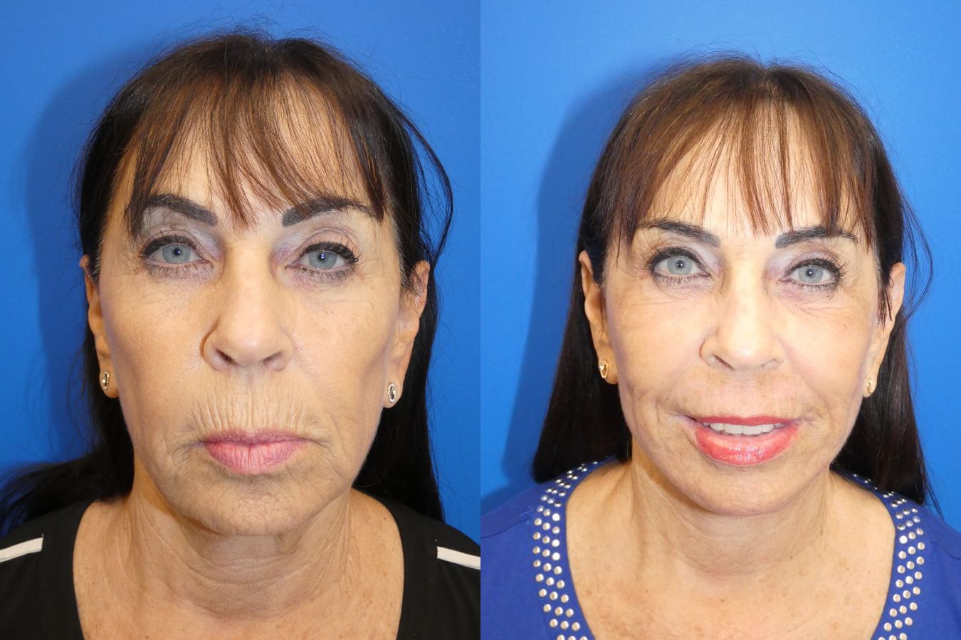 Before and after Facelift case 24015