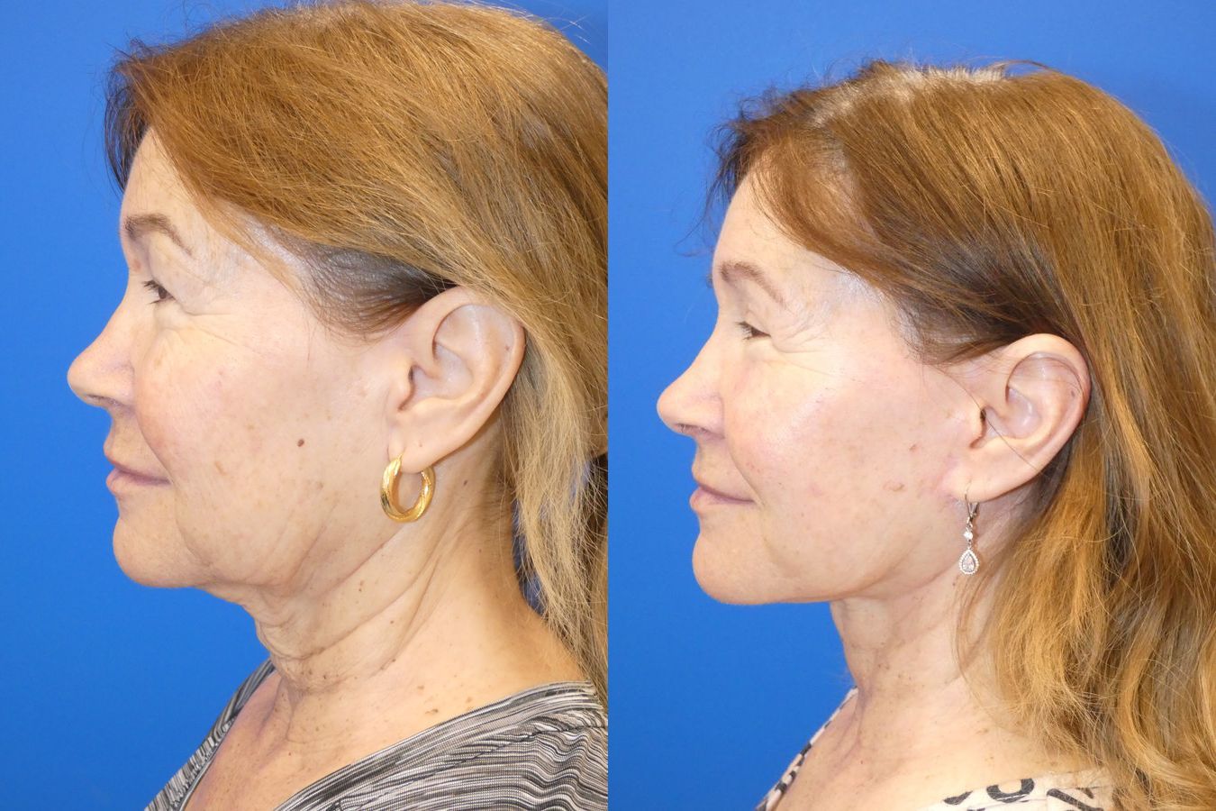 Before and after Facelift case 46281