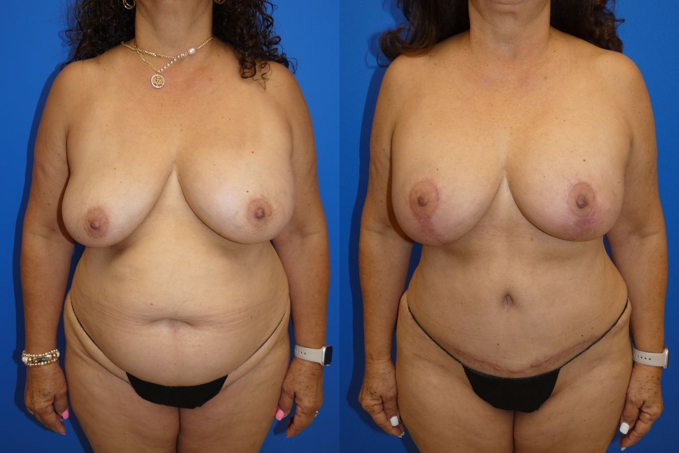 Before and after Mommy Makeover case 43720