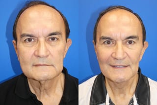 Facelift - Angle 1