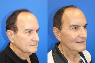 Facelift - Angle 2