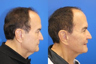 Facelift - Angle 3