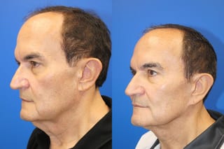 Facelift - Angle 4