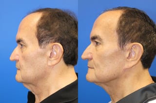 Facelift - Angle 5