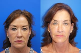Before and after Facelift case 43132 - Angle 3