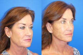 Before and after Facelift case 43132 - Angle 2
