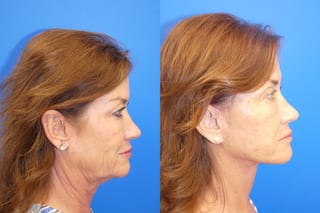 Before and after Facelift case 43132 - Angle 1