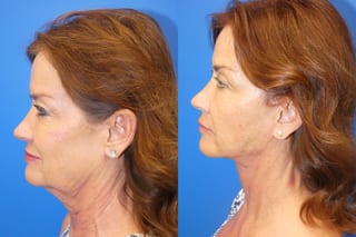 Before and after Facelift case 43132 - Angle 5